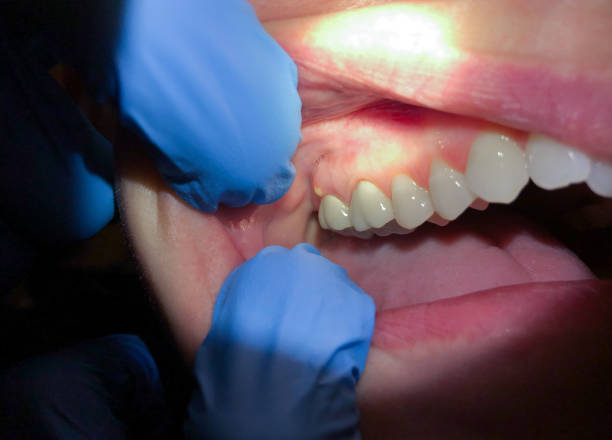Best Emergency Tooth Extraction in Brambleton, VA